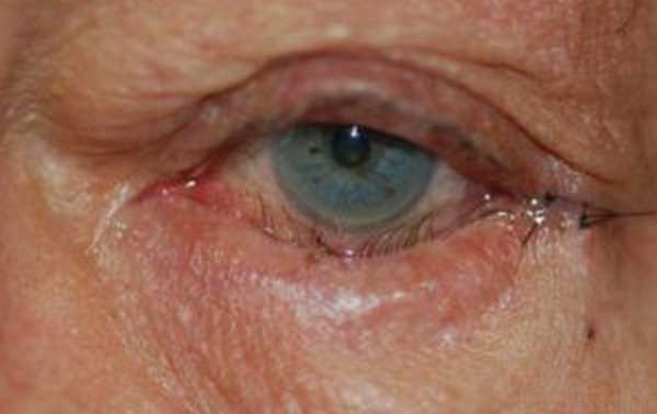фото кератопатии глаза